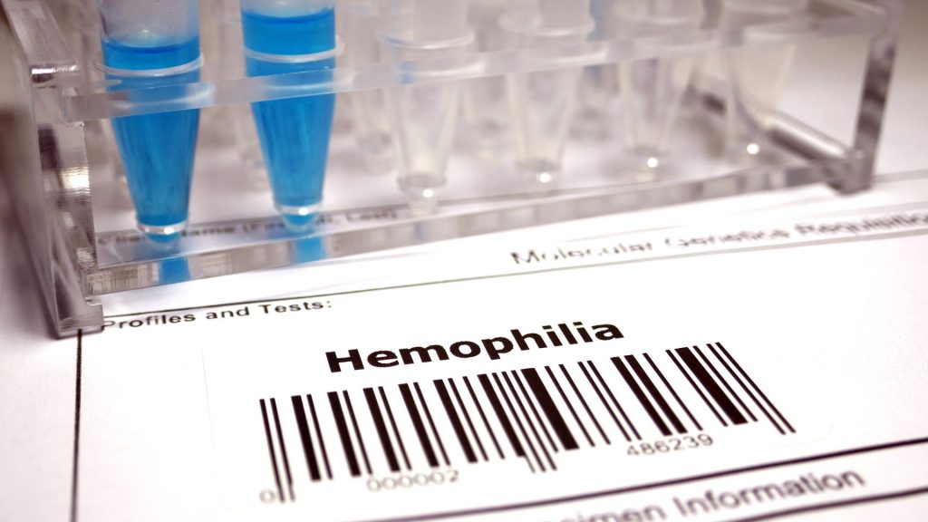 Nie każdy wie, co to hemofilia, choć wiele się o niej słyszy. Zdjęcie przedstawia badanie na hemofilię.