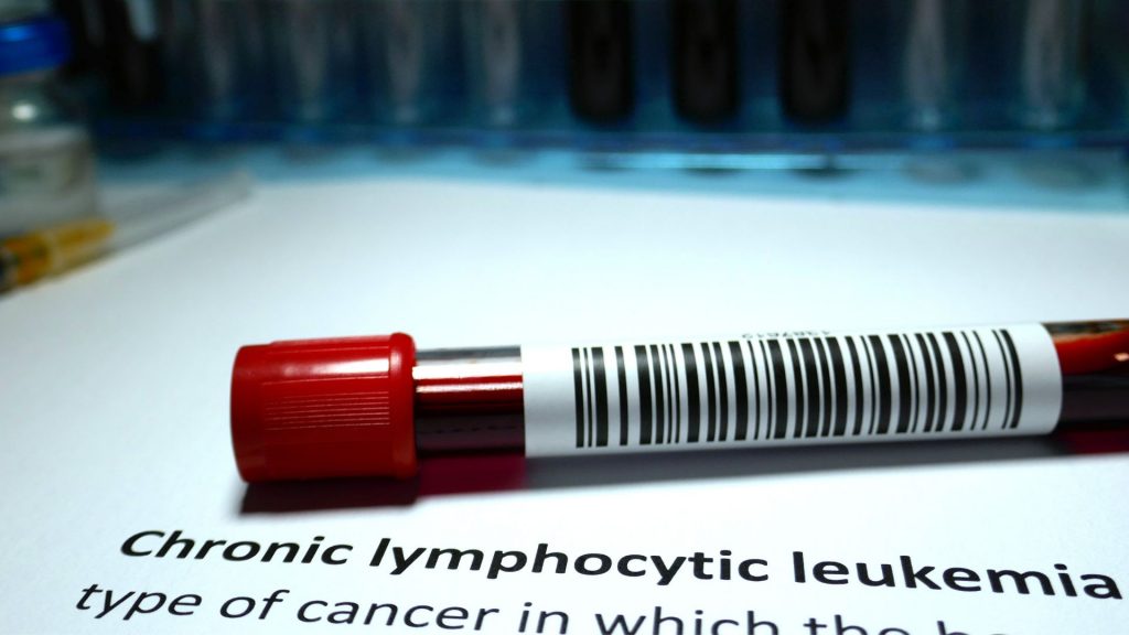 Przewlekła białaczka limfocytowa to diagnozowana za pomocą badań próbki krwi widocznej na zdjęciu.
