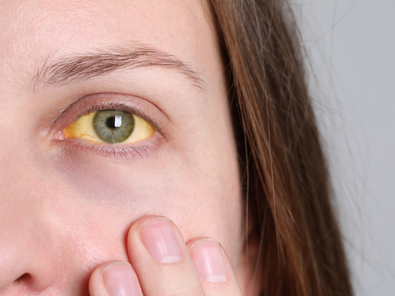 Kobieta z pożółkłymi białkami oczu, które świadczą o wysokim poziomie bilirubiny